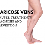 WHAT TO KNOW ABOUT VARICOSE VEIN AND ITS TREATMENT IN FLORIDA